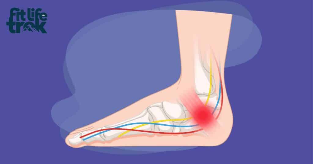 Tarsal tunnel syndrome